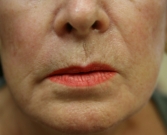 Feel Beautiful - Hyaluronan gel (Expression) around lips - Before Photo